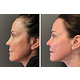 skin resurfacing