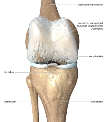 3D Modell des Knies nach arthritischen Knies