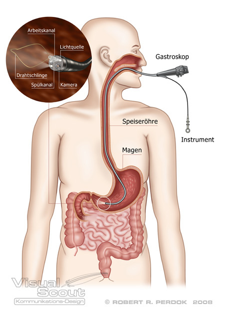 Gastroskopie (Magenspiegelung)