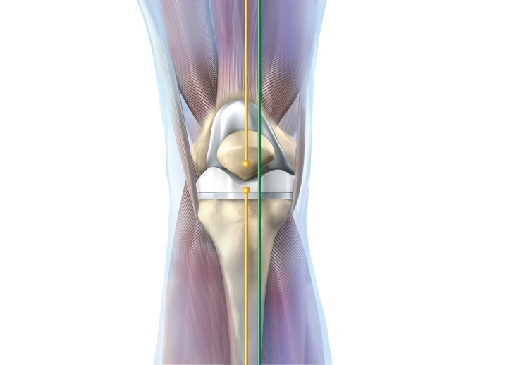 knee implant