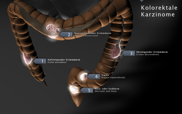 Kolorektale Karzinome (für die Lehre)