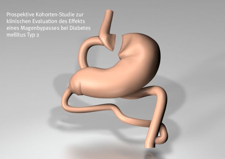 Magenbypasses bei Diabetes mellitus Typ 2 / www.klinikum.uni-heidelberg.de/Diabeteschirurgie.120580.0.html