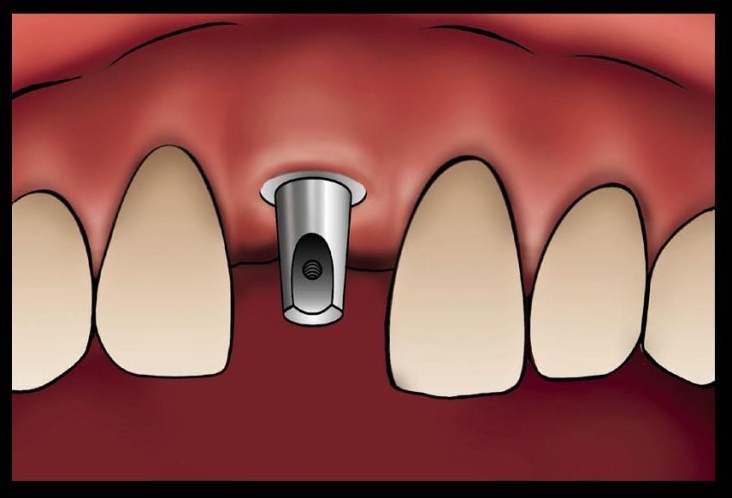 Poster für Implantate in Zahnarztpraxis. Kunde Friatec.