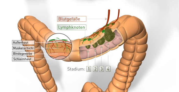 Darm / Tumor