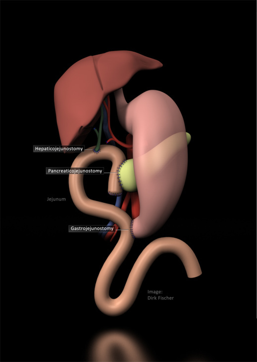 Schema ppWhipple für Chirurgie