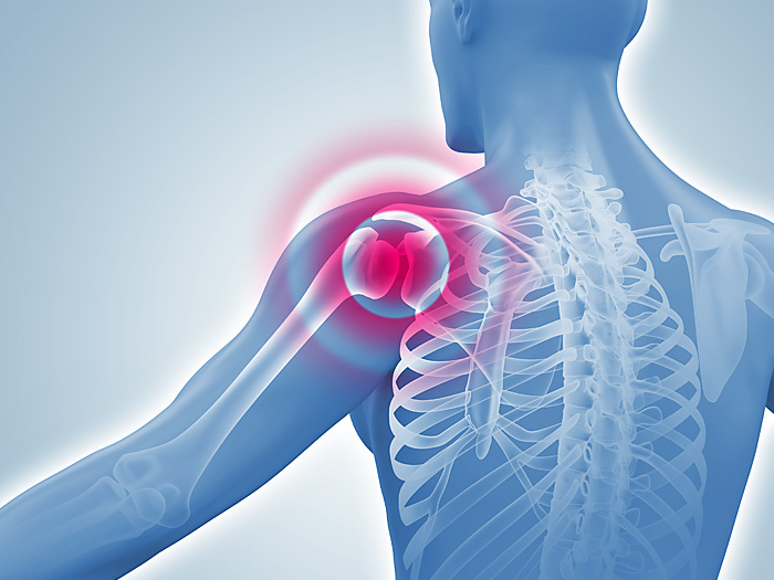 Medizinische 3D-Illustrationen / anatomische 3D-Grafiken: Gelenkschmerzen im Schulterbereich
