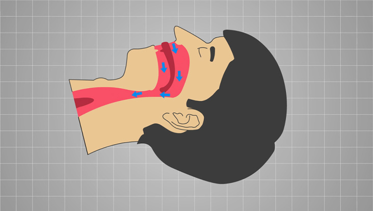 Medizinisches Schema snore-no-more