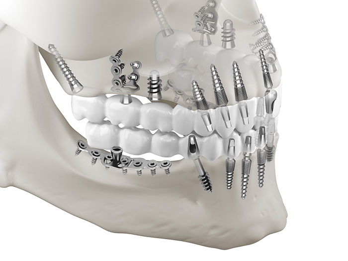 Zahnimplantate: medizinische 3D-Visualisierung / 3D-Illustrationen von Schraubenimplantaten und Plattenimplantaten