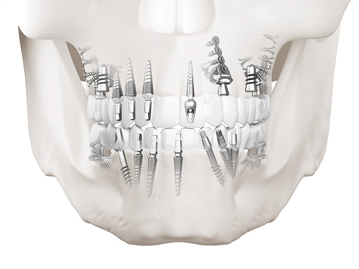 Zahnimplantaten, Knochenimplantaten, Schraubenimplantaten, Plattenimplantaten: 3D-Visualisierungen / 3D-Illustrationen