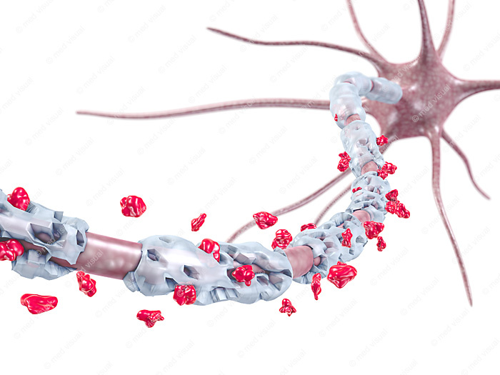 Entzündung der Myelinscheide, Nervenfaser einer Nervenzelle: medizinische 3D-Illustrationen
