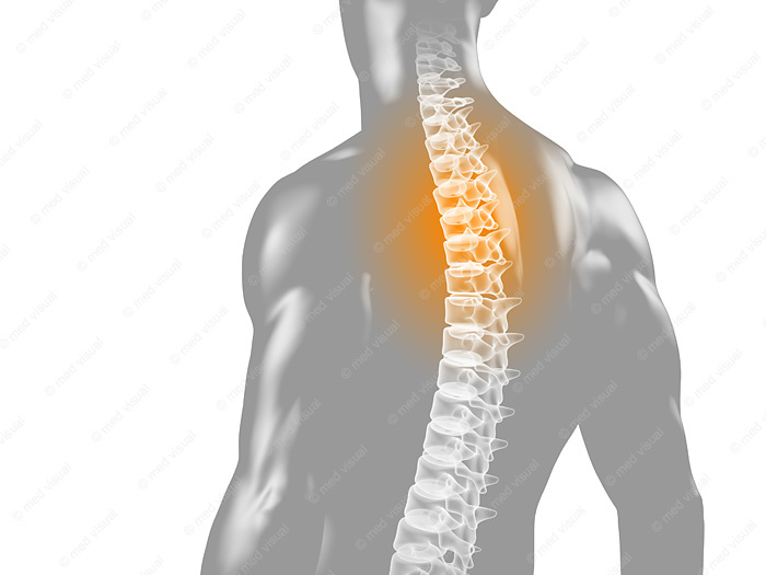 Rückenschmerzen – medizinische 3D Visualisierung