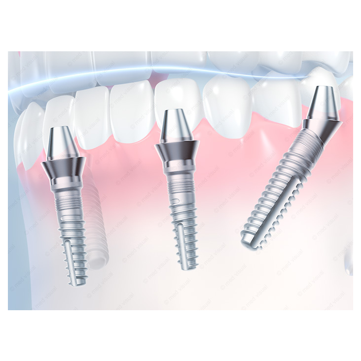 Zahnimplantate: Medizinische Illustrationen