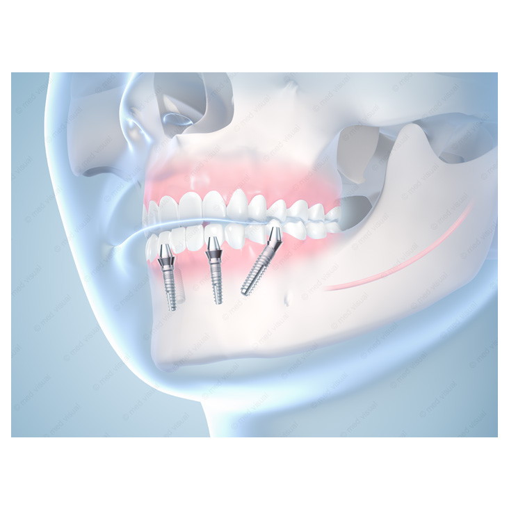 Medizinische Illustrationen von Zahnimplantaten