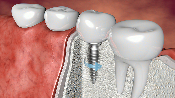 Implantat bp