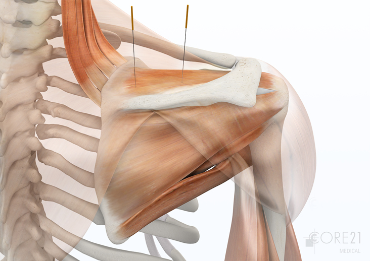 medizinische Illustration – Akupunktur der Schulter