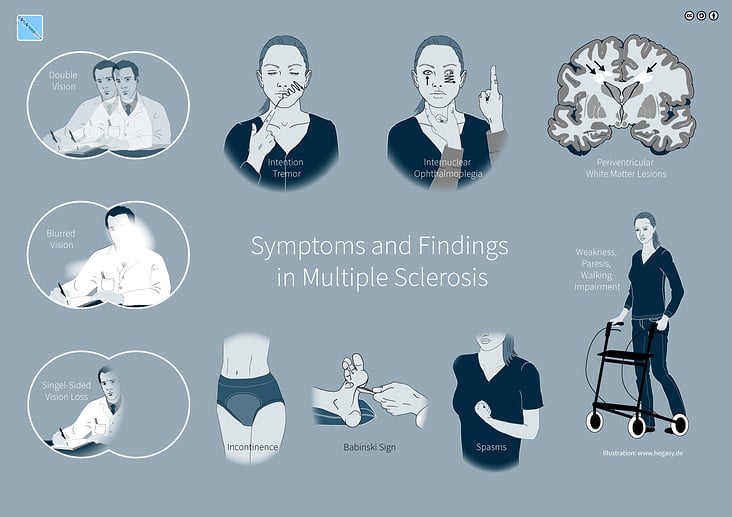Mögliche Symptome und Befunde der Multiplen Sklerose
