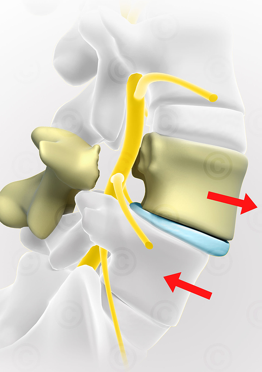 Rückenschmerzen – Wirbelgleiten