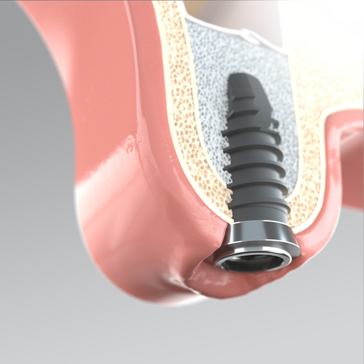 Thommen Medical – Implantologie Visuals