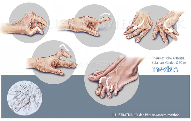 Rheumatische Arthritis, Hand, Fuß