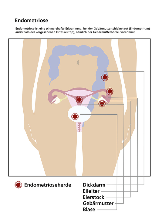 sk-grafik endometriose