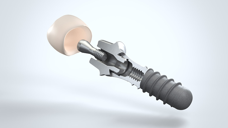 3D Animation Zahnimplantate