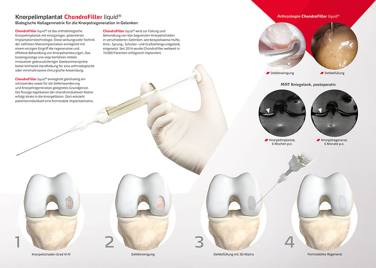 Informationsflyer ChondroFiller liquid Innenseiten