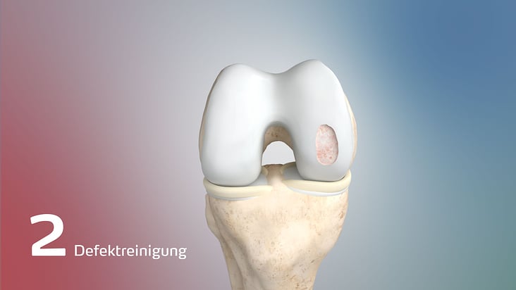 Anatomievisualisierung: Defektreinigung