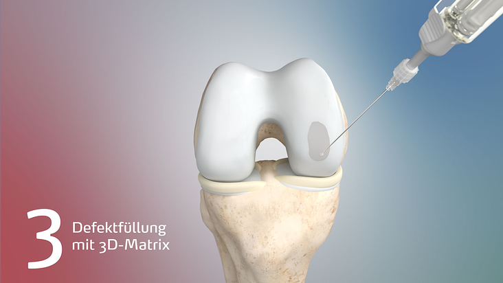 Anatomievisualisierung: Defektfüllung mit 3D-Matrix