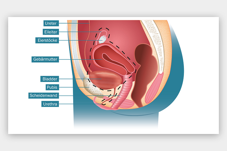 Blasenkrebs Illustrationen – Anatomie Frau