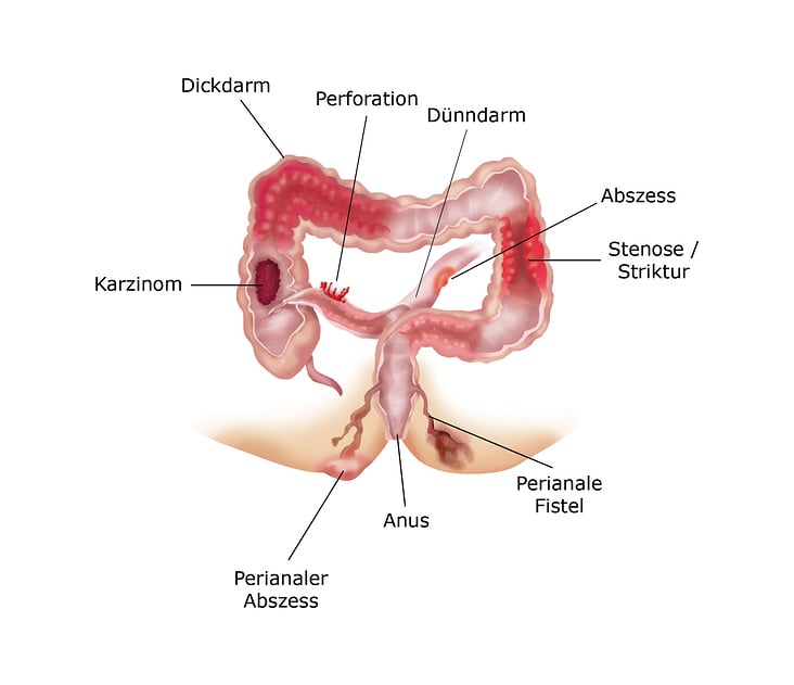 Erkrankungen des Darms