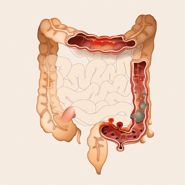 Pathologie des Dickdarms