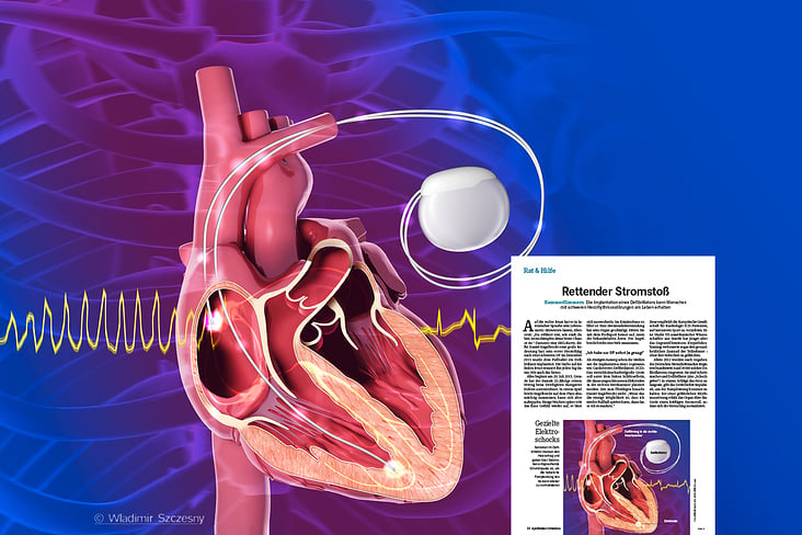 Funktionsweise eines Herzschrittmachers