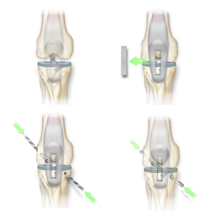 ACL tear final