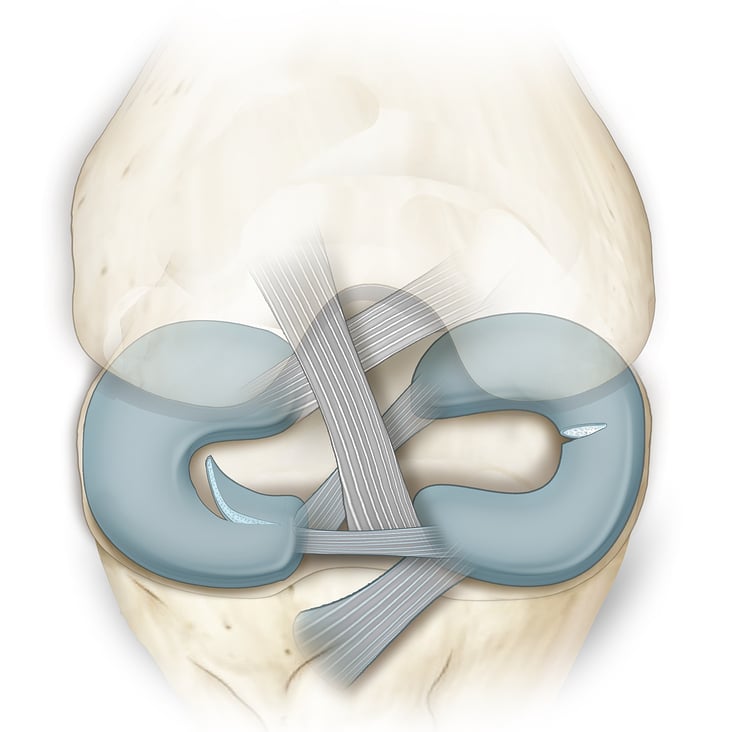 meniscus2 riss