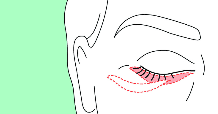Infobroschüre „Augenlidstraffung“