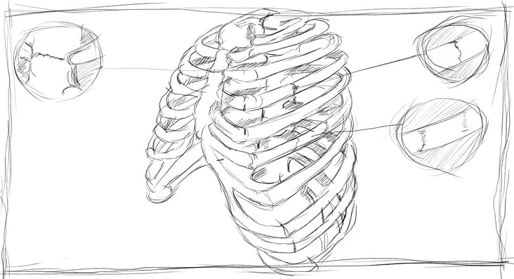 MedXpert STRACOS 3D‑Rippenklammer 3D-Animation Storyboard