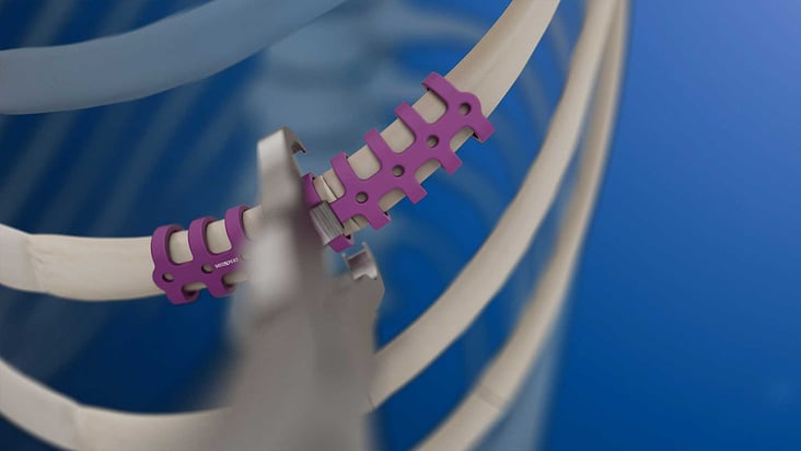 MedXpert STRACOS 3D‑Rippenklammer 3D-Animation Anwendung