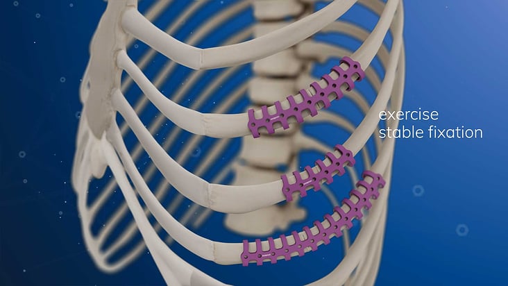 MedXpert STRACOS 3D‑Rippenklammer 3D-Animation Anwendung