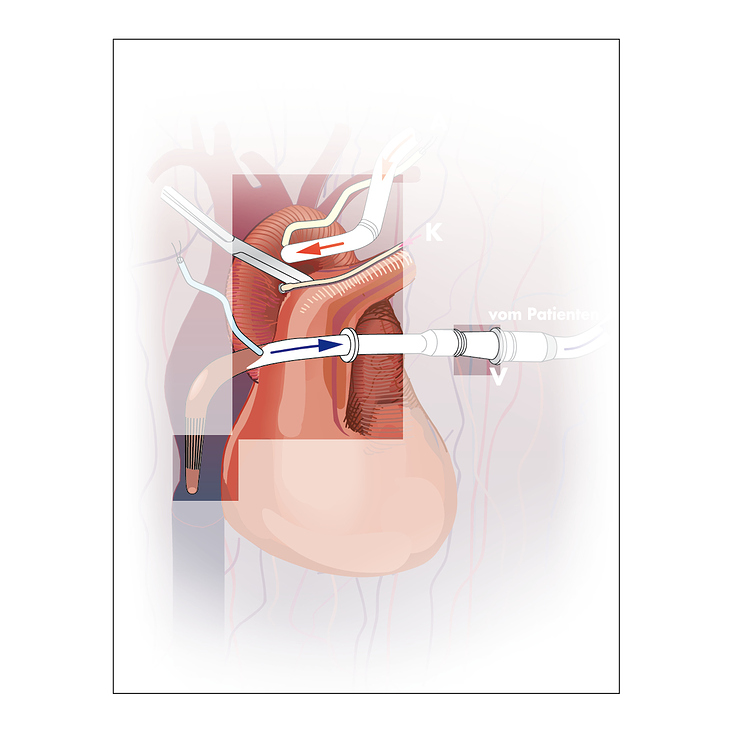 Illustration für Kongressposter ­– Herzoperation