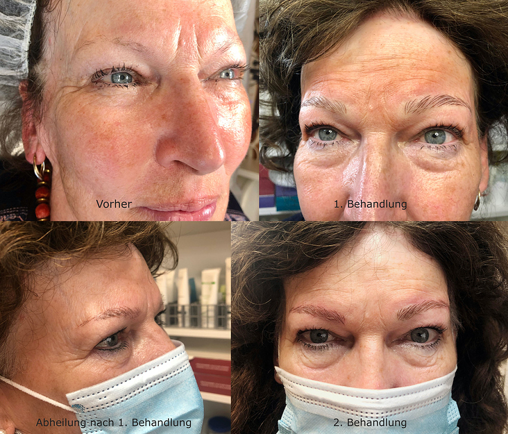 Microblading