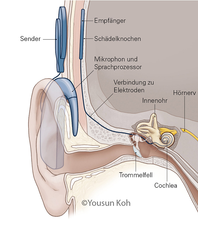 Cochlea-Implantat