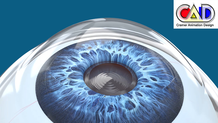 Augen-OP intraokulare Linse