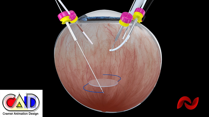 Augen-OP IOL multifocal