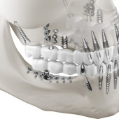 „Zahnimplantaten und Knochenimplantaten“ von AG Visualisierung / Studio für 3D…