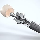 „3D Animation Zahnimplantate“ von Stefan Hähnlein