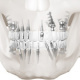 Zahnimplantaten, Knochenimplantaten, Schraubenimplantaten, Plattenimplantaten: 3D-Visualisierungen / 3D-Illustrationen