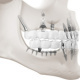 Zahnimplantaten, Knochenimplantaten, Schraubenimplantaten, Plattenimplantaten: 3D-Visualisierungen / 3D-Grafik