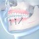 Medizinische Illustrationen von Zahnimplantaten