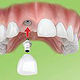 Dentales Implantat