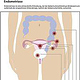 sk-grafik endometriose